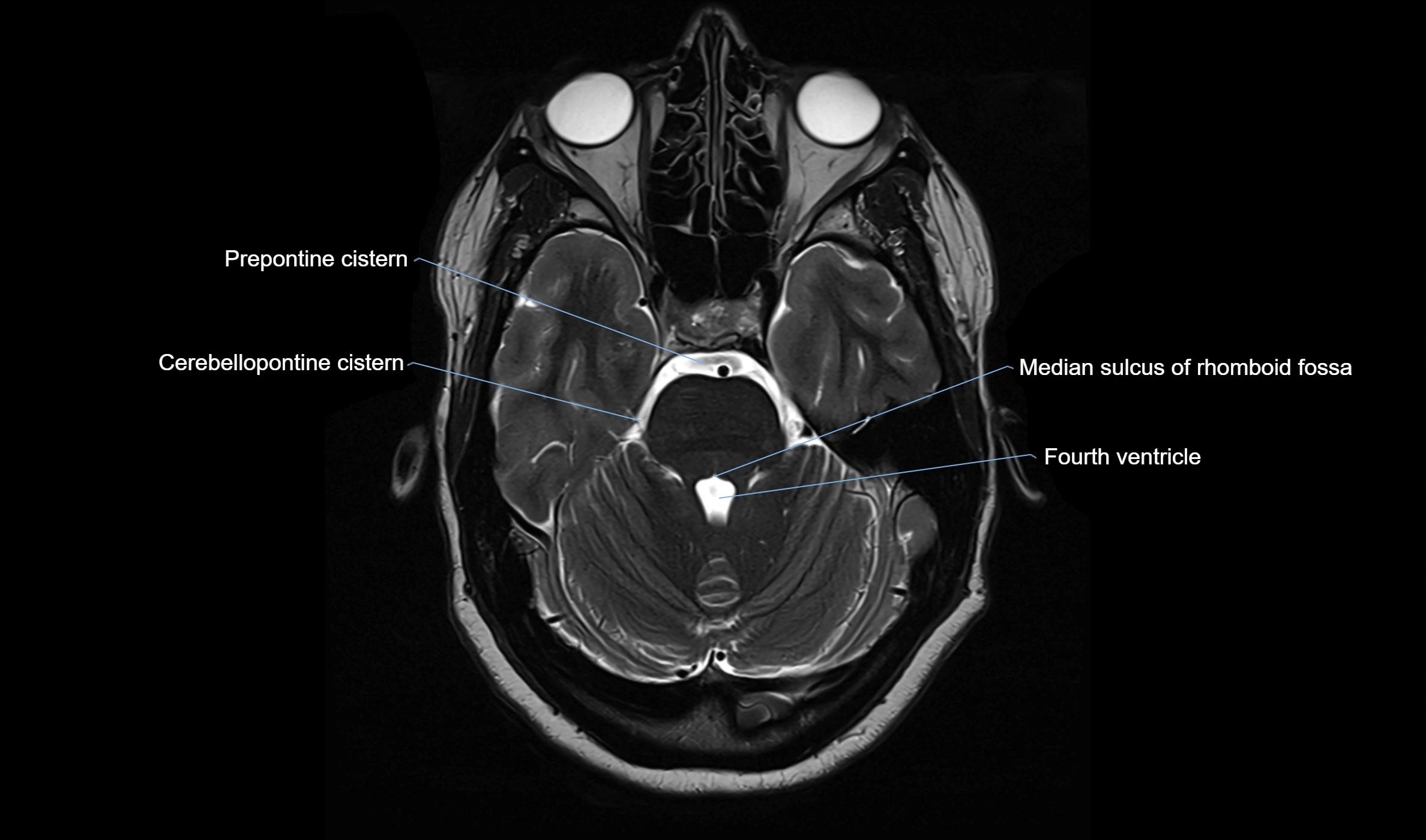 Brain cisterns  and ventricles  axial anatomy 3T MRI image-img-00001-00016.webp